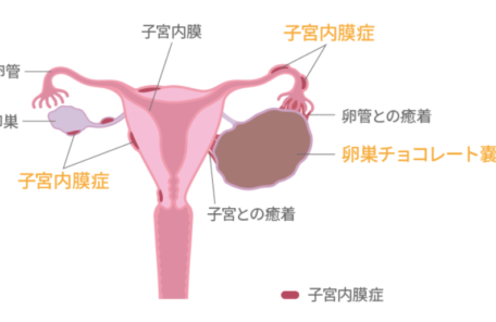 卵巣嚢腫イラスト