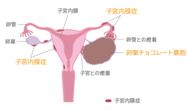 卵巣嚢腫イラスト