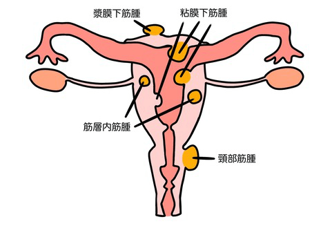 子宮筋腫イラスト