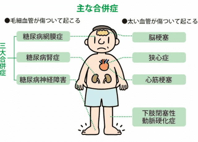 糖尿病による合併症