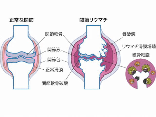 リウマチの症状